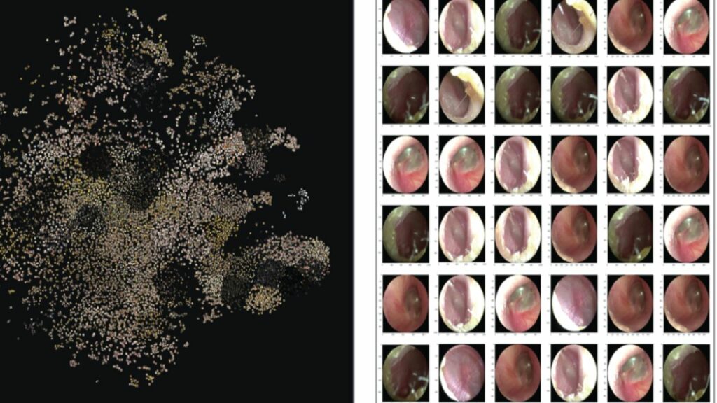 otitis media-1